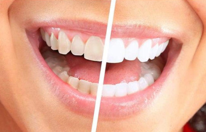 جهاز Luma Smile Tooth Polisher Whitener لتبييض الاسنان 4