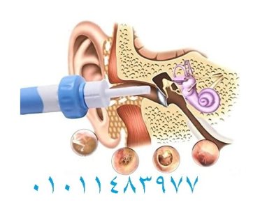 جهاز تنضيف الاذن بواسطة الشفط 1
